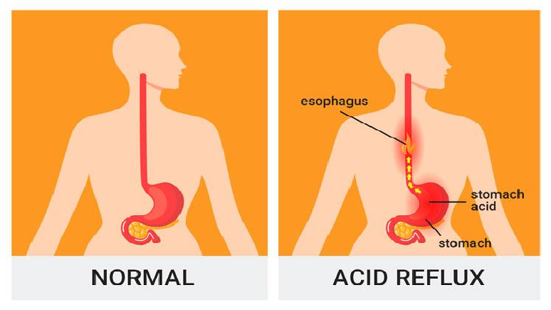 7-side-effects-of-drinking-lemon-water-4.jpg